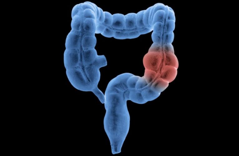 Half of new colon and rectal cancer diagnoses are now in people age 66 and younger, report finds