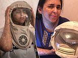 Woman with rare genetic condition wears ‘space helmet’ to protect her skin from the sun