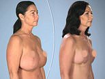 Mother-of-two asks Botched doctors to reduce the size of her breasts