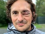 Tory MP Johnny Mercer gives thumbs up as reveals huge black eye from canoeing accident