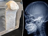Pig fat used to grow jawbones in FIVE weeks could help millions suffering with joint dysfunction