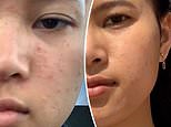 Student reveals the diet and skincare regime that cleared up her ’embarrassing’ acne using JS Health