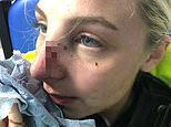 Female police officer shows horrific facial injuries inflicted on her by 16-year-old boy