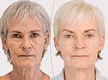 Judy Murray reveals results of £4,500 non-surgical facelift which makes her look 10 years younger