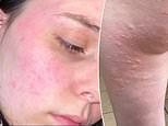 Student, 19, who won haul of Boohoo clothes in competition claims her prizes left her with rashes