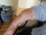 Woman, 85, in agony with broken arm for 18 MONTHS as three operations cancelled