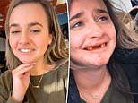 Woman knocks out her teeth after getting drunk on bottomless mimosas
