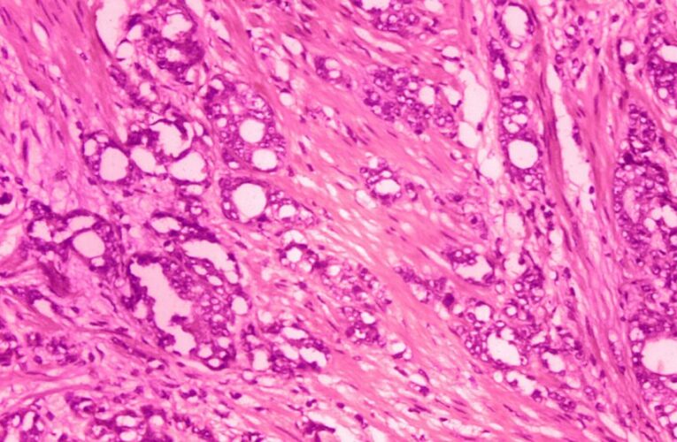 ‘Next big wave’: Radiation drugs track and kill cancer cells