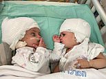 Conjoined twins joined at the head look at each other for the first time after surgery in Israel