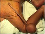 The boy born with a TAIL: Brazilian baby gets 12cm-long appendage chopped off