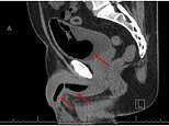 Impotent man’s partner accidentally deploys insulation foam inside his urethra during sex act