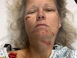 Army veteran, 55, left with life-changing injuries after she was trampled by a herd of cows