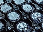 Covid can cause regions of the brain to SHRINK