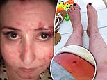 Woman with rare skin picking condition dermatillomania nearly lost LEG due to infection from wounds