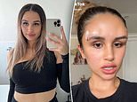 Young woman, 21, is left with forehead lumps after getting a fox eye thread lift