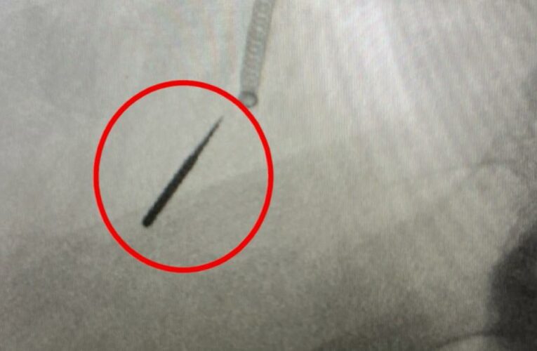 Man inhales dental drill bit into lung during procedure