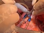 Ukrainian surgeons remove a bullet from the beating heart of a soldier wounded in Kyiv [Video]