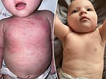 Baby so coated in angry red eczema is ‘cured overnight’ by &pound;7.99 cream&nbsp;