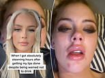 Woman’s lips swelled up because she drank alcohol after getting fillers