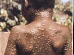 Two more people have been diagnosed with monkeypox in UK in case not linked to previous infection