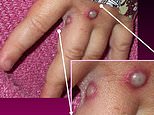 Q&A: How deadly is monkeypox, is there a cure, how is it treated and how worried should I be?