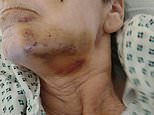 Disabled pensioner is hospitalised after she was savagely attacked by RAT as she slept in her home 