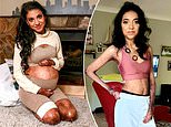 Johannesburg woman has skin so fragile it blisters at the slightest touch