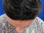 Alopecia drug regrows hair in 40% of patients with condition suffered by Jada Pinkett-Smith