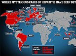 Another 18 British children are struck down with mysterious hepatitis ‘of unknown origin’